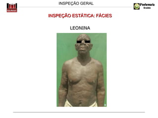 INSPEÇÃO GERAL

INSPEÇÃO ESTÁTICA: FÁCIES
LEONINA

 