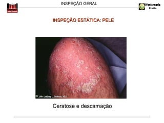INSPEÇÃO GERAL

INSPEÇÃO ESTÁTICA: PELE

Ceratose e descamação

 