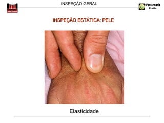 INSPEÇÃO GERAL

INSPEÇÃO ESTÁTICA: PELE

Elasticidade

 