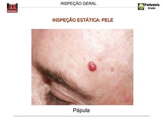 INSPEÇÃO GERAL

INSPEÇÃO ESTÁTICA: PELE

Pápula

 