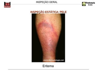 INSPEÇÃO GERAL

INSPEÇÃO ESTÁTICA: PELE

Eritema

 