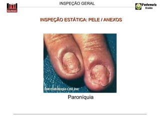 INSPEÇÃO GERAL

INSPEÇÃO ESTÁTICA: PELE / ANEXOS

Paroníquia

 