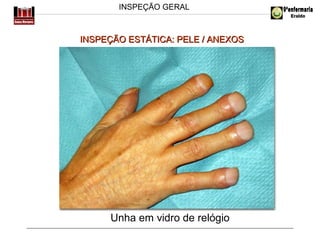 INSPEÇÃO GERAL

INSPEÇÃO ESTÁTICA: PELE / ANEXOS

Unha em vidro de relógio

 