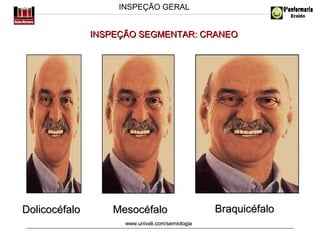 INSPEÇÃO GERAL

INSPEÇÃO SEGMENTAR: CRANEO

Dolicocéfalo

Mesocéfalo
www.univali.com/semiologia

Braquicéfalo

 