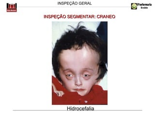 INSPEÇÃO GERAL

INSPEÇÃO SEGMENTAR: CRANEO

Hidrocefalia

 