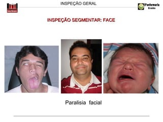 INSPEÇÃO GERAL

INSPEÇÃO SEGMENTAR: FACE

Paralisia facial

 