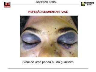 INSPEÇÃO GERAL

INSPEÇÃO SEGMENTAR: FACE

Sinal do urso panda ou do guaxinim

 
