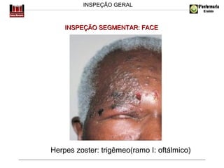 INSPEÇÃO GERAL

INSPEÇÃO SEGMENTAR: FACE

Herpes zoster: trigêmeo(ramo I: oftálmico)

 