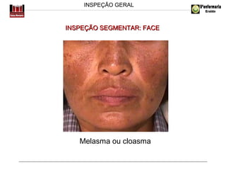 INSPEÇÃO GERAL

INSPEÇÃO SEGMENTAR: FACE

Melasma ou cloasma

 