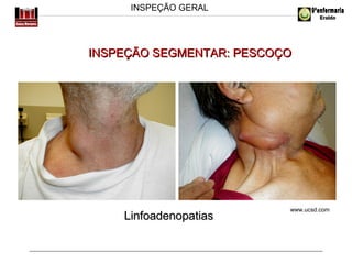 INSPEÇÃO GERAL

INSPEÇÃO SEGMENTAR: PESCOÇO

Linfoadenopatias

www.ucsd.com

 