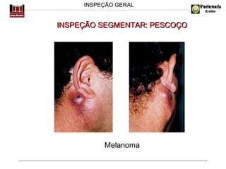 INSPEÇÃO GERAL

INSPEÇÃO SEGMENTAR: PESCOÇO

Melanoma

 