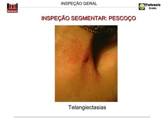 INSPEÇÃO GERAL

INSPEÇÃO SEGMENTAR: PESCOÇO

Telangiectasias

 