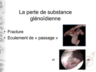 La perte de substance
glénoïdienne
• Fracture
• Eculement de « passage »
AVAR
 