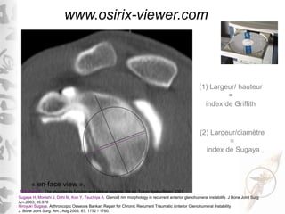 (1) Largeur/ hauteur
=
index de Griffith
(2) Largeur/diamètre
=
index de Sugaya
« en-face view ».
www.osirix-viewer.com
No...