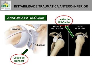 INSTABILIDADE TRAUMÁTICA ANTERO-INFERIOR
ANATOMIA PATOLÓGICA
Lesão de
Bankart
Lesão de
Hill-Sachs
 