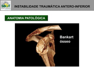 INSTABILIDADE TRAUMÁTICA ANTERO-INFERIOR
ANATOMIA PATOLÓGICA
Bankart
ósseo
 