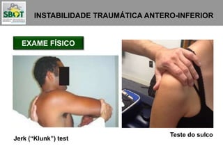 INSTABILIDADE TRAUMÁTICA ANTERO-INFERIOR
EXAME FÍSICO
Jerk (“Klunk”) test
Teste do sulco
 