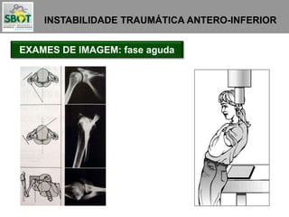 INSTABILIDADE TRAUMÁTICA ANTERO-INFERIOR
EXAMES DE IMAGEM: fase aguda
 