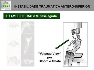 INSTABILIDADE TRAUMÁTICA ANTERO-INFERIOR
EXAMES DE IMAGEM: fase aguda
“Velpeau View”
por
Bloom e Obata
 