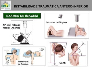 INSTABILIDADE TRAUMÁTICA ANTERO-INFERIOR
EXAMES DE IMAGEM
AP com rotação
medial (Adams)
Incisura de Stryker
West Point
de Rokous
Garth
 