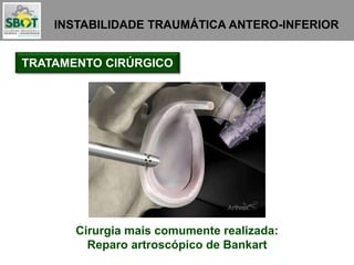 INSTABILIDADE TRAUMÁTICA ANTERO-INFERIOR
TRATAMENTO CIRÚRGICO
Cirurgia mais comumente realizada:
Reparo artroscópico de Bankart
 