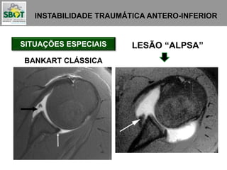 INSTABILIDADE TRAUMÁTICA ANTERO-INFERIOR
SITUAÇÕES ESPECIAIS LESÃO “ALPSA”
BANKART CLÁSSICA
 