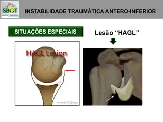 INSTABILIDADE TRAUMÁTICA ANTERO-INFERIOR
SITUAÇÕES ESPECIAIS Lesão “HAGL”
 