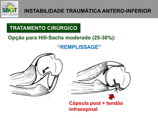 INSTABILIDADE TRAUMÁTICA ANTERO-INFERIOR
TRATAMENTO CIRÚRGICO
Opção para Hill-Sachs moderado (25-30%):
“REMPLISSAGE”
Cápsula post + tendão
infraespinal
 