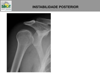 INSTABILIDADE POSTERIOR
Podem passar despercebidas
em até 50% das vezes
 