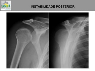INSTABILIDADE POSTERIOR
Podem passar despercebidas
em até 50% das vezes
 
