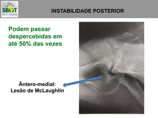 INSTABILIDADE POSTERIOR
Podem passar
despercebidas em
até 50% das vezes
Ântero-medial:
Lesão de McLaughlin
 