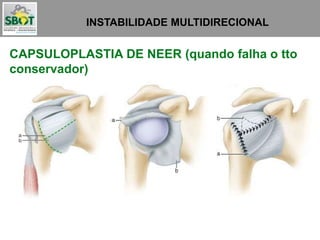 INSTABILIDADE MULTIDIRECIONAL
CAPSULOPLASTIA DE NEER (quando falha o tto
conservador)
 