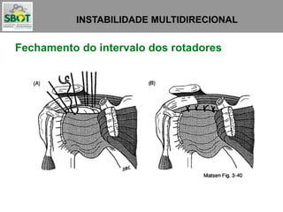 INSTABILIDADE MULTIDIRECIONAL
Fechamento do intervalo dos rotadores
 