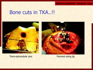Bone cuts in TKA..!! 
Antero-posterior femoral cuts 
Trans-epicondylar axis Femoral sizing jig 
 