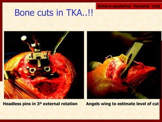 Bone cuts in TKA..!! 
Antero-posterior femoral cuts 
Headless pins in 3º external rotation Angels wing to estimate level of cut 
 