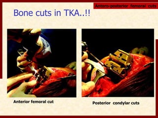 Bone cuts in TKA..!! 
Antero-posterior femoral cuts 
Anterior femoral cut Posterior condylar cuts 
 