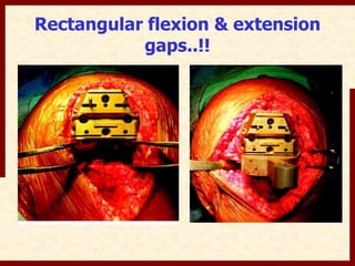 Rectangular flexion & extension 
gaps..!! 
 