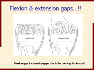 Flexion & extension gaps…!! 
Flexion gap & extension gaps should be rectangular & equal 
 