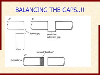 BALANCING THE GAPS..!! 
 
