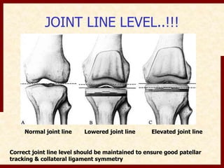 JOINT LINE LEVEL..!!! 
Normal joint line Lowered joint line Elevated joint line 
Correct joint line level should be maintained to ensure good patellar 
tracking & collateral ligament symmetry 
 