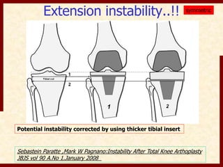 Extension instability..!! 
Potential instability corrected by using thicker tibial insert 
symmetric 
Sebastein Paratte ,Mark W Pagnano:Instability After Total Knee Arthoplasty 
JBJS vol 90 A.No 1.January 2008 
 