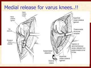 Medial release for varus knees..!! 
 