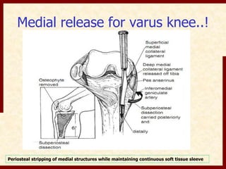Medial release for varus knee..! 
Periosteal stripping of medial structures while maintaining continuous soft tissue sleeve 
 