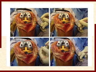 Needle puncturing is new,effective,and safe technique for 
correction of MCL tightness in varus knees 
 