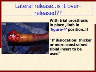 Lateral release..is it over-released?? 
With trial prosthesis 
in place ,limb in 
‘figure-4’ position..!! 
“If dislocation: thicker 
or more constrained 
tibial insert to be 
used” 
 