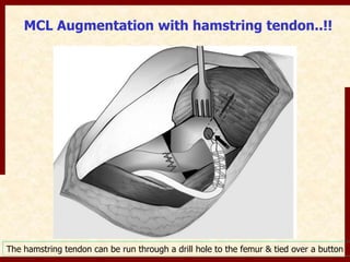 MCL Augmentation with hamstring tendon..!! 
The hamstring tendon can be run through a drill hole to the femur & tied over a button 
 