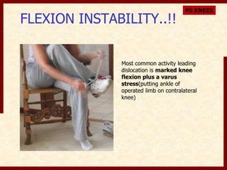 FLEXION INSTABILITY..!! 
PS KNEES 
Most common activity leading 
dislocation is marked knee 
flexion plus a varus 
stress(putting ankle of 
operated limb on contralateral 
knee) 
 