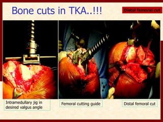 Bone cuts in TKA..!!! Distal femoral cut 
Intramedullary jig in 
desired valgus angle 
Femoral cutting guide Distal femoral cut 
 