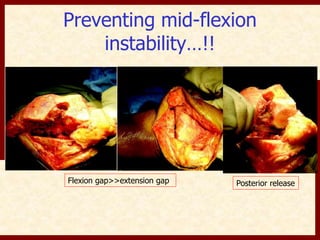 Preventing mid-flexion 
instability…!! 
Flexion gap>>extension gap Posterior release 
 