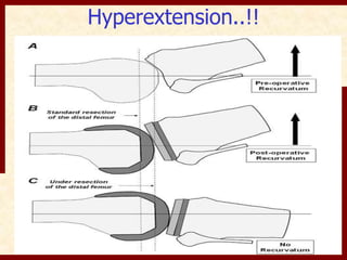 Hyperextension..!! 
 